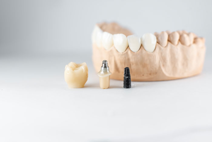 mini dental implantlar