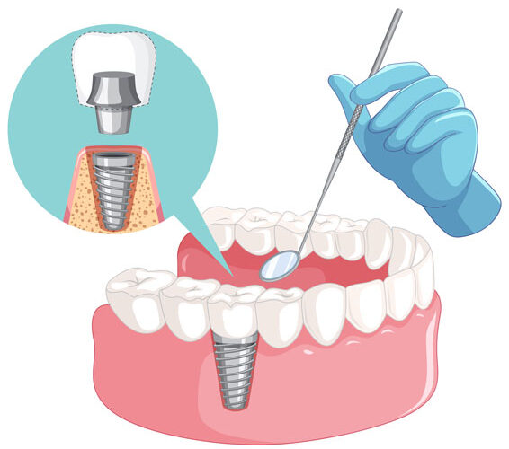 immediat-implant-dis immediat implant