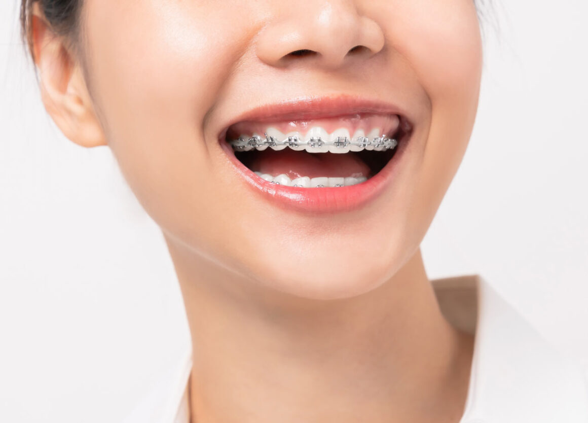 Ortodonti Tedavisi