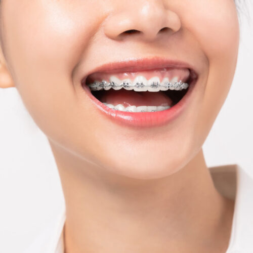 ortodonti-dental-klinik-mecidiyeköy Ortodonti Tedavisi