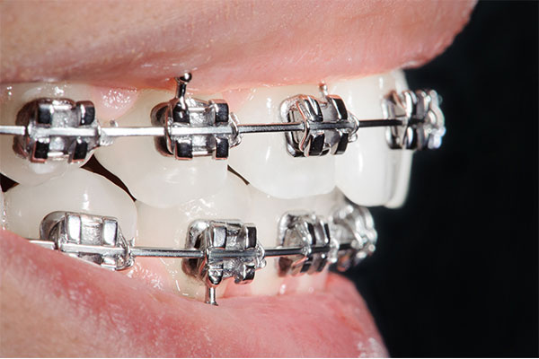 ortodonti uzmanı nedir fiyatları diş teli tedavisi 