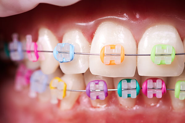 seramik braket diş teli tedavisi