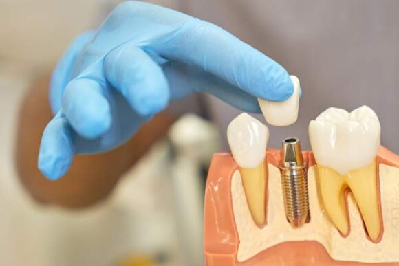 Implant Diş Tedavisi - İstanbul Diş Kliniği- Dentallaid