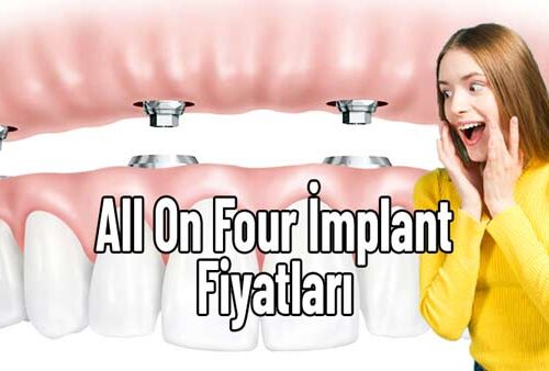 all on four implant fiyatları, all on four implant