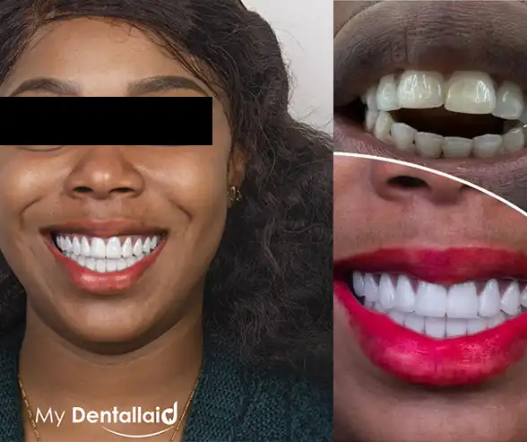 Zirkonyum Kaplama İle Restore Edilen Öncesi ve Sonrası Fotoğraf
