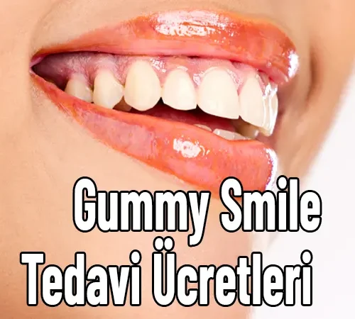 Gummy Smile Nedir? Belirtileri ve Tedavi Seçenekleri Nelerdir?